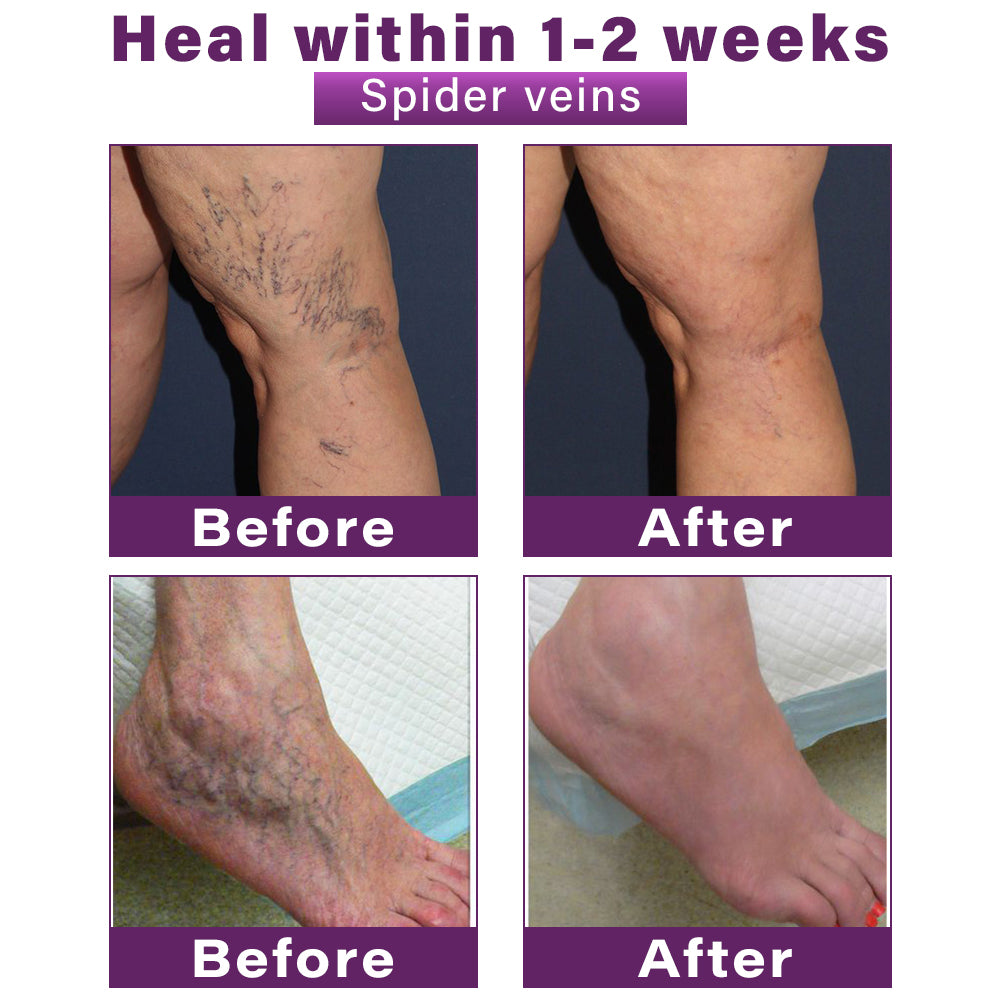 CVREOZ® Polidocanol Nano Varicose Vein Patch 💜⭐ HOT SALE 60% 🤩