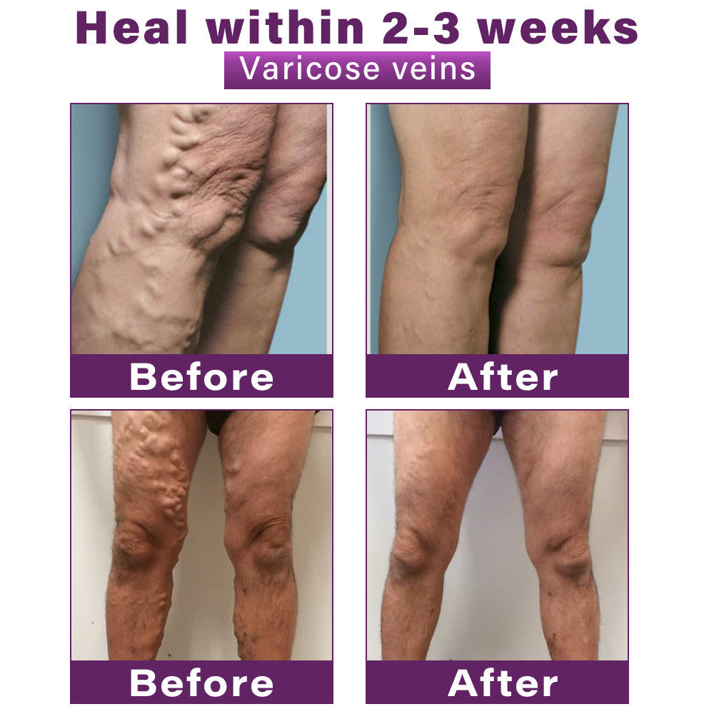 CVREOZ® Polidocanol Nano Varicose Vein Patch 💜⭐ HOT SALE 60% 🤩