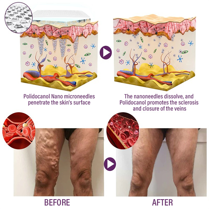 ⏰Last Day Promotion: 60% OFF🔥Crveoz® NanoPoli Varicose Vein Patch.