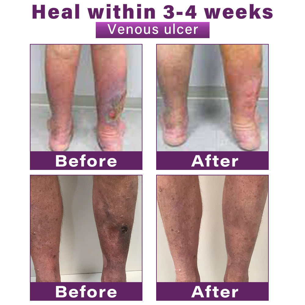 CVREOZ® Polidocanol Nano Varicose Vein Patch 💜⭐ HOT SALE 60% 🤩