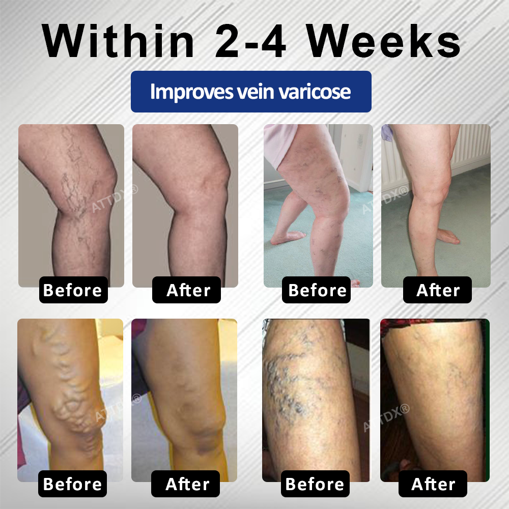 Cvreoz® MagniLift VeinErase Spray