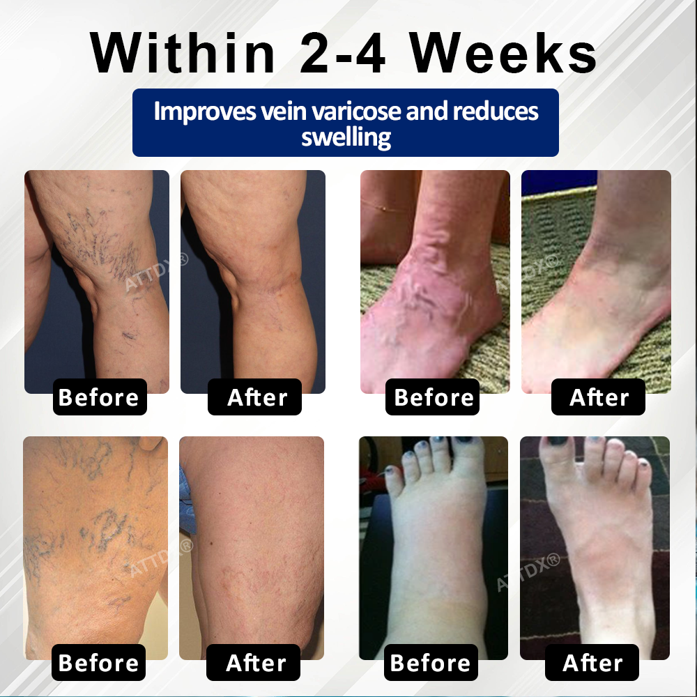 CvreozÂź VeinFocus Microneedle Leg Patch