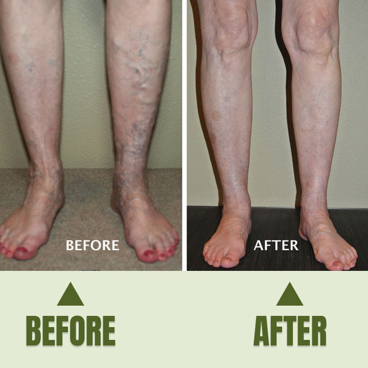 đ„ Last Day Promotion: 60% OFF đ„ CvreozÂź Varicose Veins Healing Cream