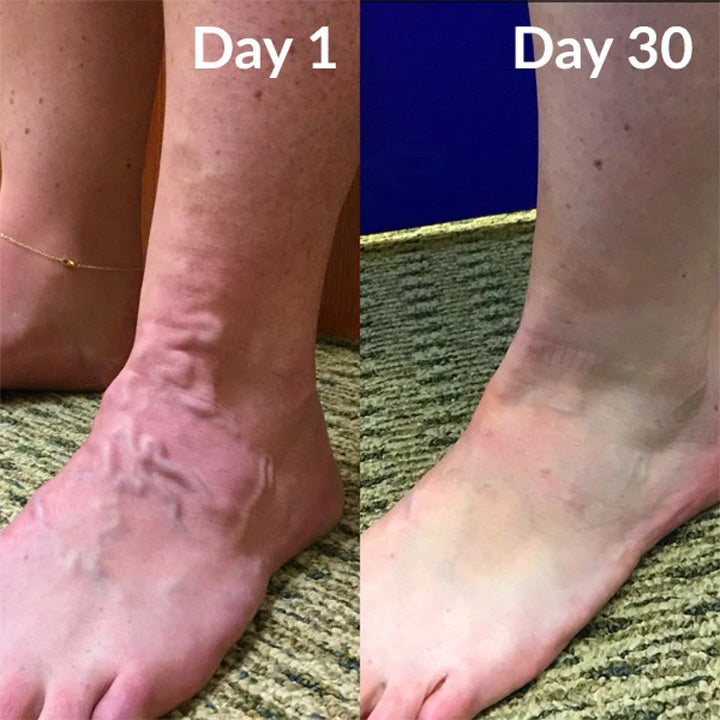 đ„ Last Day Promotion: 60% OFF đ„ CvreozÂź Varicose Veins Healing Cream