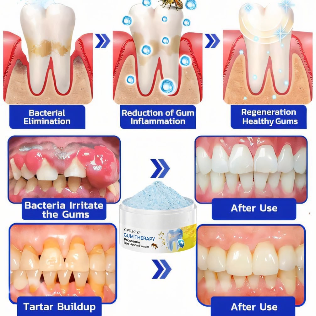 CVREOZ® Gum Therapy Focussmile Bee Venom Powder 🔬 Clinically Trusted by Dentists 🦷