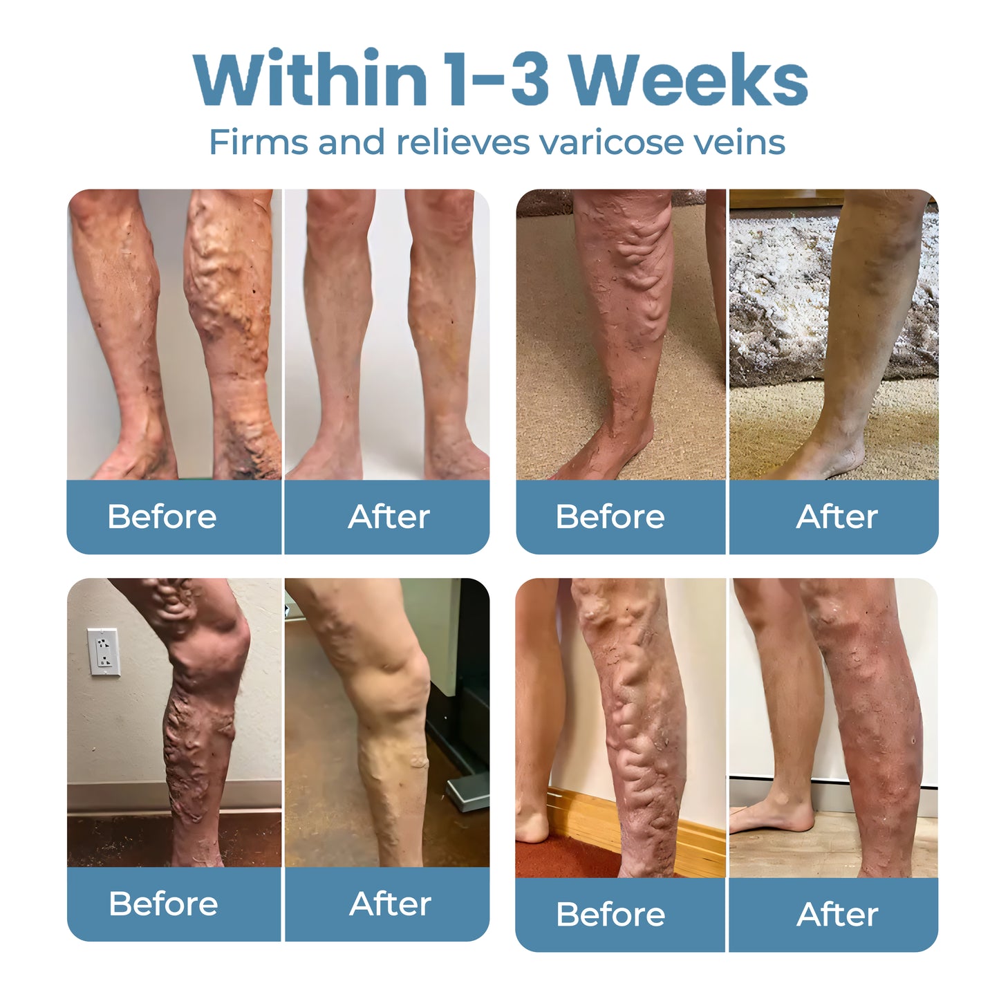 🔥Last Deal: 60% Off🔥 CVREOZ® Herbal Relief Varicose Vein Spray