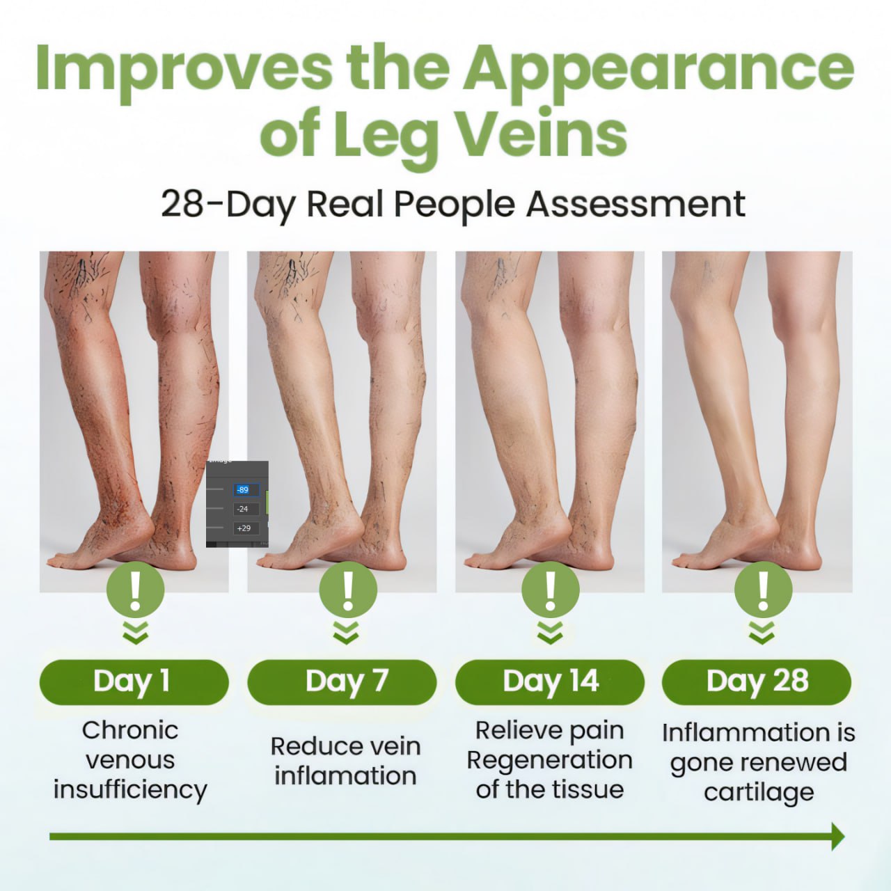 đ„ Last Day Promotion: 60% OFF đ„ CvreozÂź Varicose Veins Healing Cream
