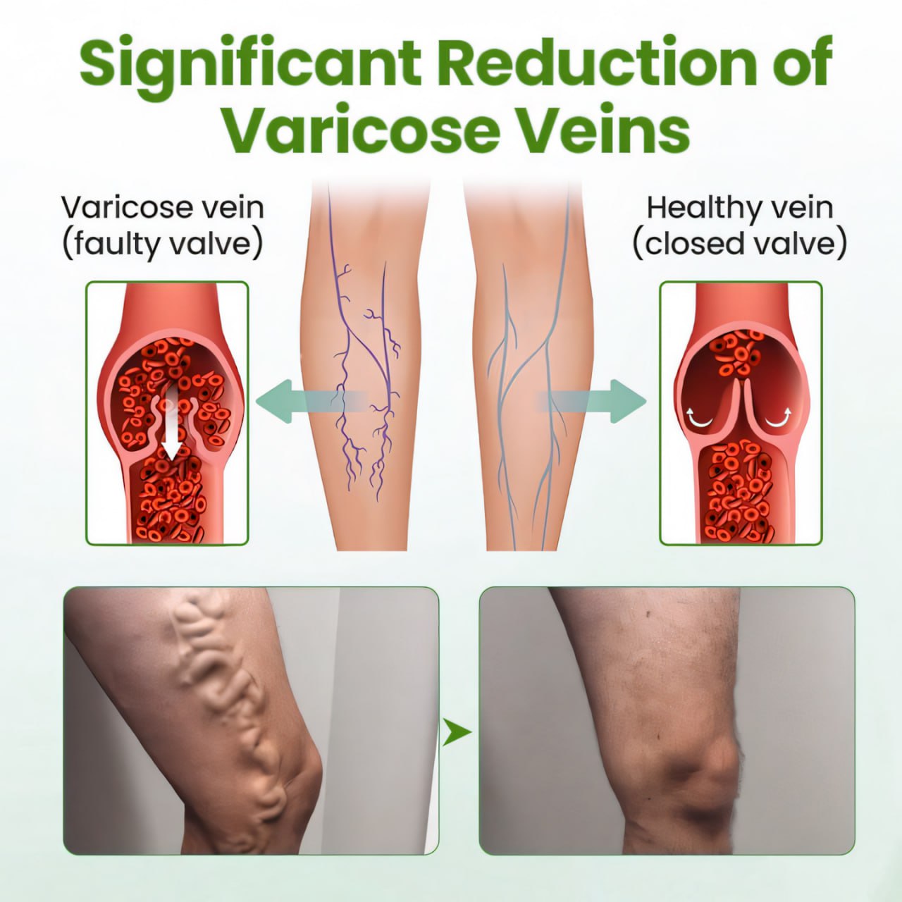 đ„ Last Day Promotion: 60% OFF đ„ CvreozÂź Varicose Veins Healing Cream