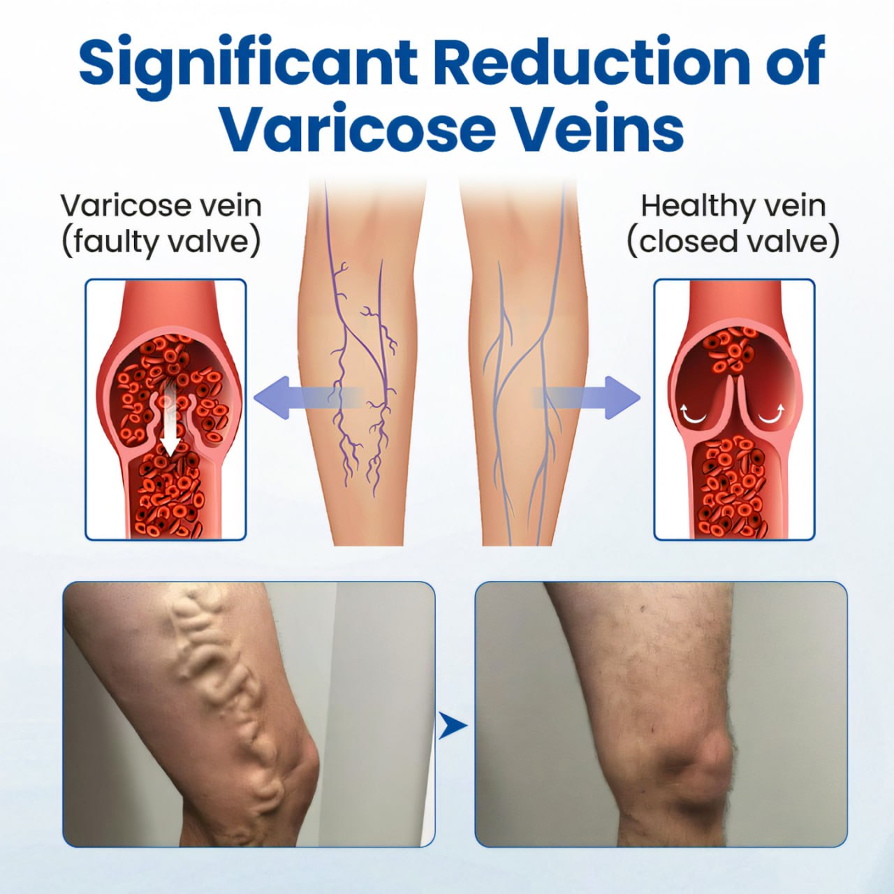 Cvreoz® Varicose Veins Patch🔥Last Sale: 60% OFF⏰