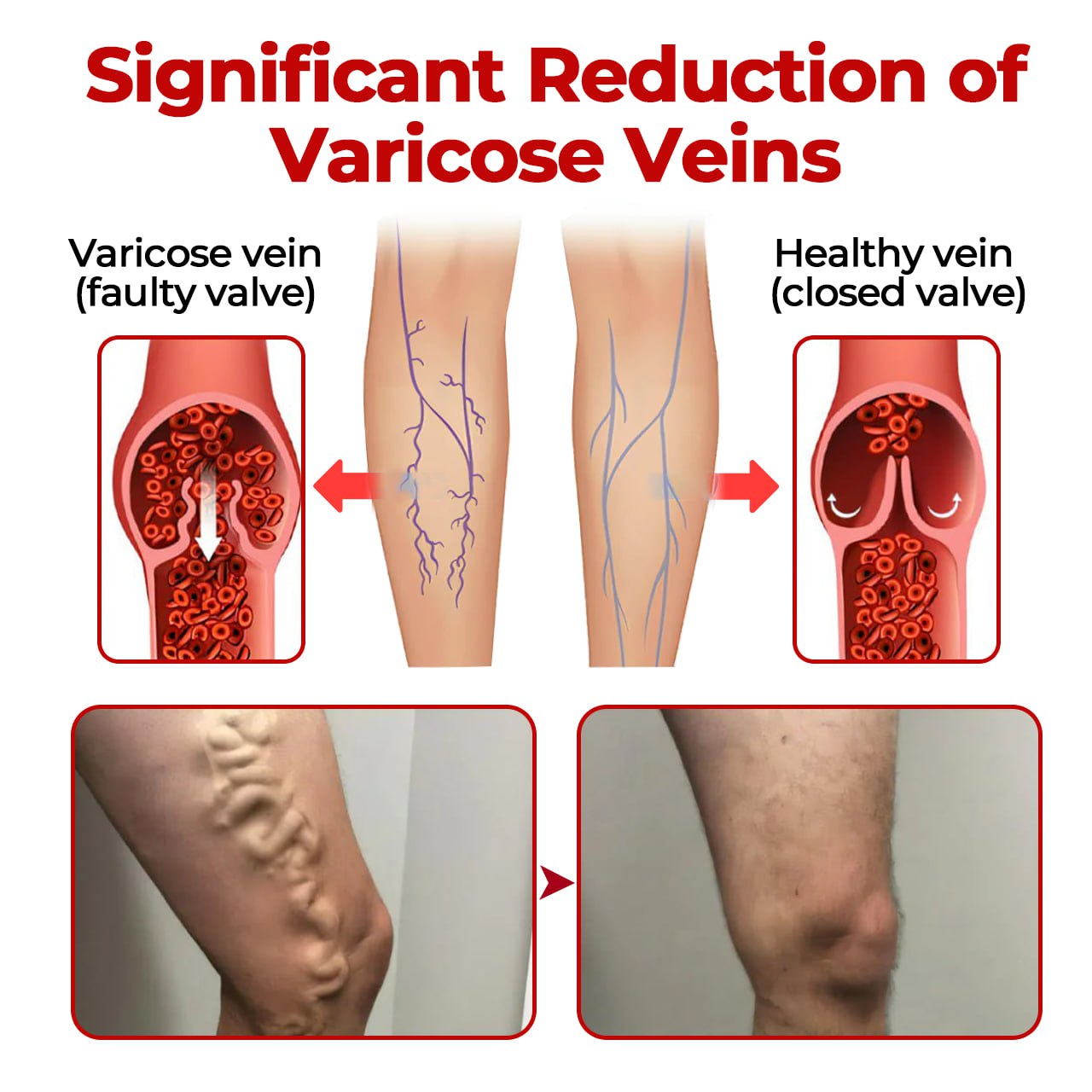 CVREOZ® Varicose Veins Patch Ultra
