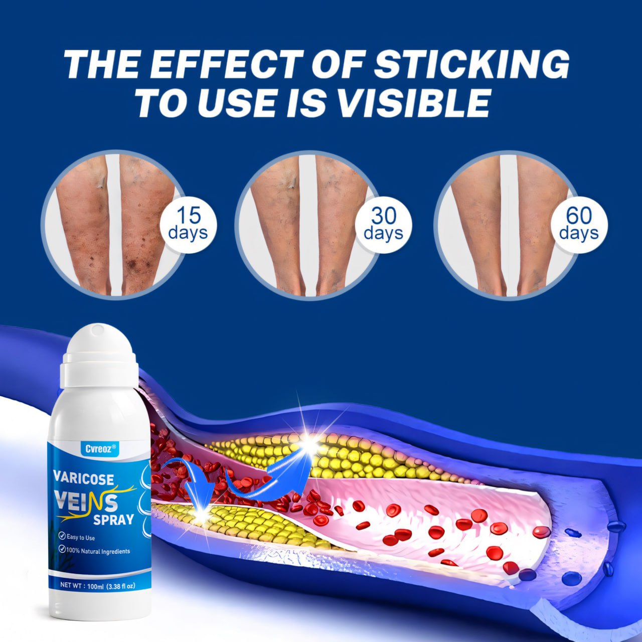 ⏰Last Day Promotion: 60% OFF🔥Cvreoz® VenoAid Varicose Vein Spray