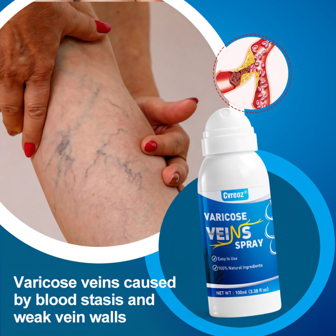 ⏰Last Day Promotion: 60% OFF🔥Cvreoz® VenoAid Varicose Vein Spray