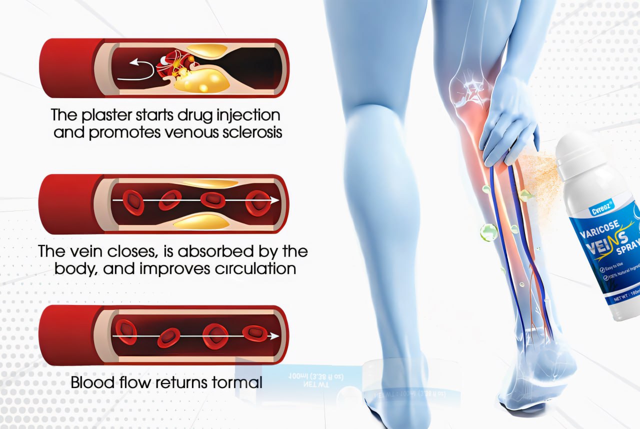 ⏰Last Day Promotion: 60% OFF🔥Cvreoz® VenoAid Varicose Vein Spray