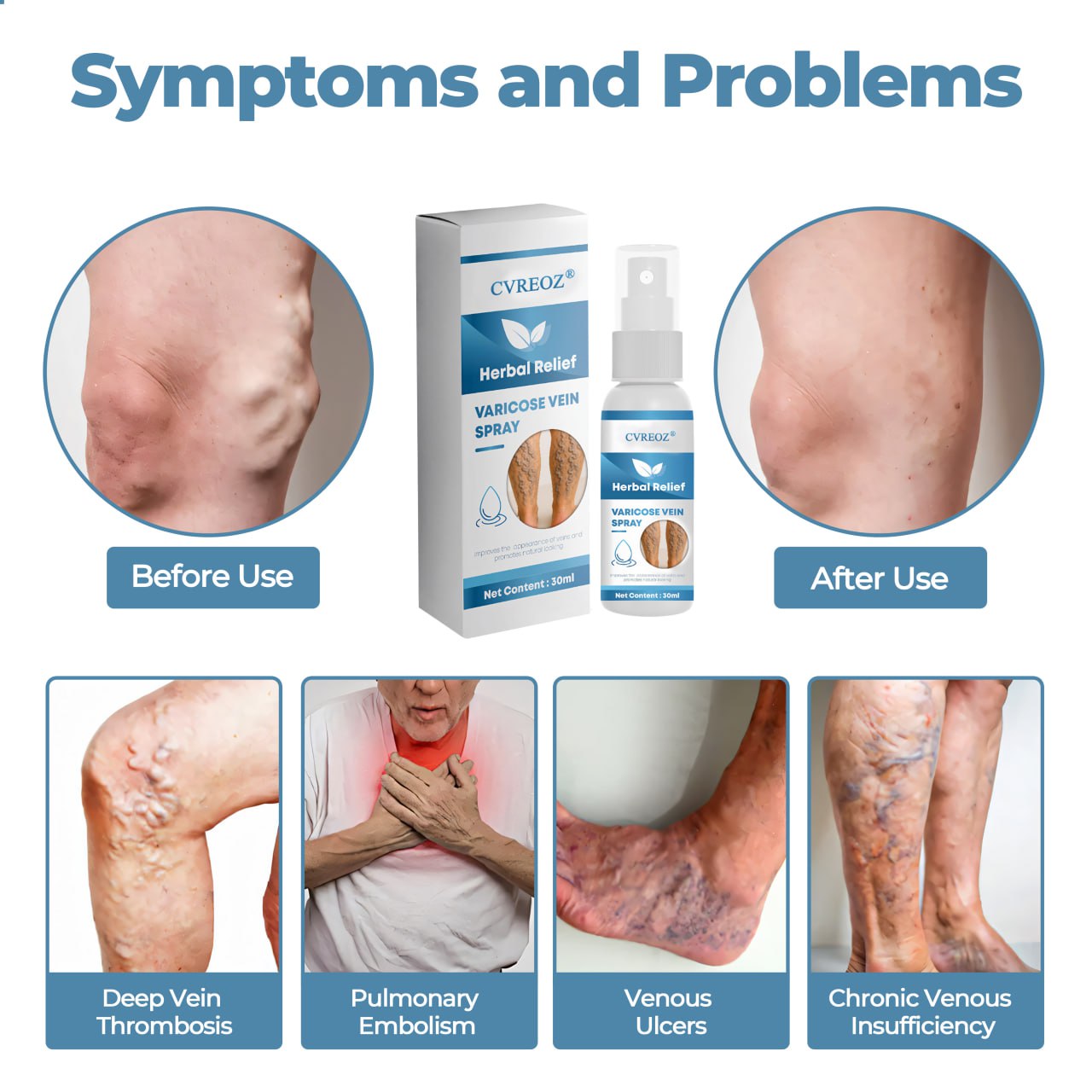 🔥Last Deal: 60% Off🔥 CVREOZ® Herbal Relief Varicose Vein Spray