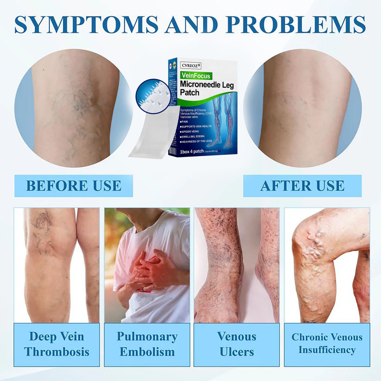 CvreozÂź VeinFocus Microneedle Leg Patch