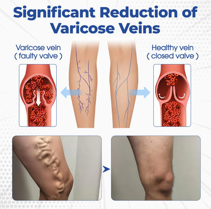 ⏰Last Day Promotion: 60% OFF🔥Cvreoz® VenoAid Varicose Vein Spray