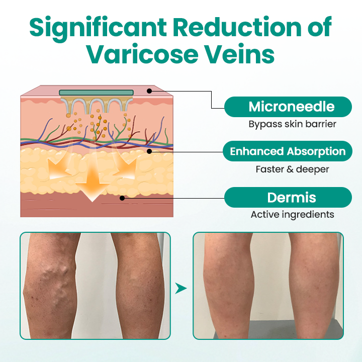 🎉SPECIAL OFFER: 60% OFF This Today Only!🔥 Cvreoz® LegRenew Varicose Veins Patch