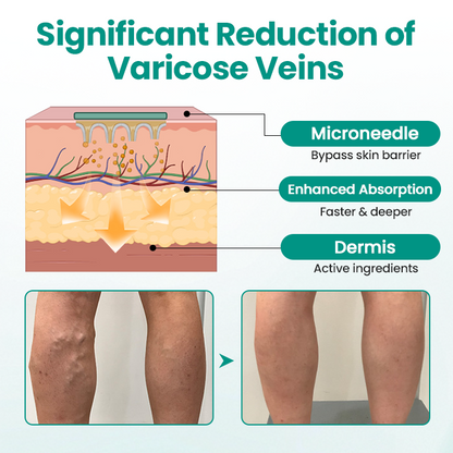 🎉SPECIAL OFFER: 60% OFF This Today Only!🔥 Cvreoz® LegRenew Varicose Veins Patch