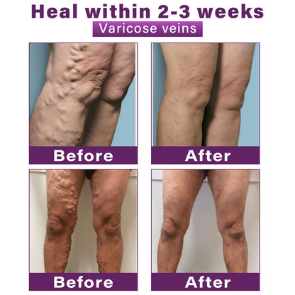 CVREOZ® Polidocanol Nano Varicose Vein Patch 💜⭐ HOT SALE 60% 🤩