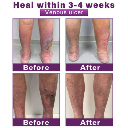 CVREOZ® Polidocanol Nano Varicose Vein Patch 💜⭐ HOT SALE 60% 🤩