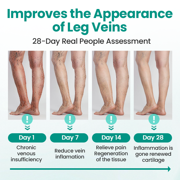 🎉SPECIAL OFFER: 60% OFF This Today Only!🔥 Cvreoz® LegRenew Varicose Veins Patch