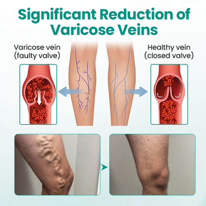 🎉SPECIAL OFFER: 60% OFF This Today Only!🔥 Cvreoz® LegRenew Varicose Veins Patch