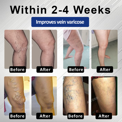 Cvreoz® MagniLift VeinErase Spray