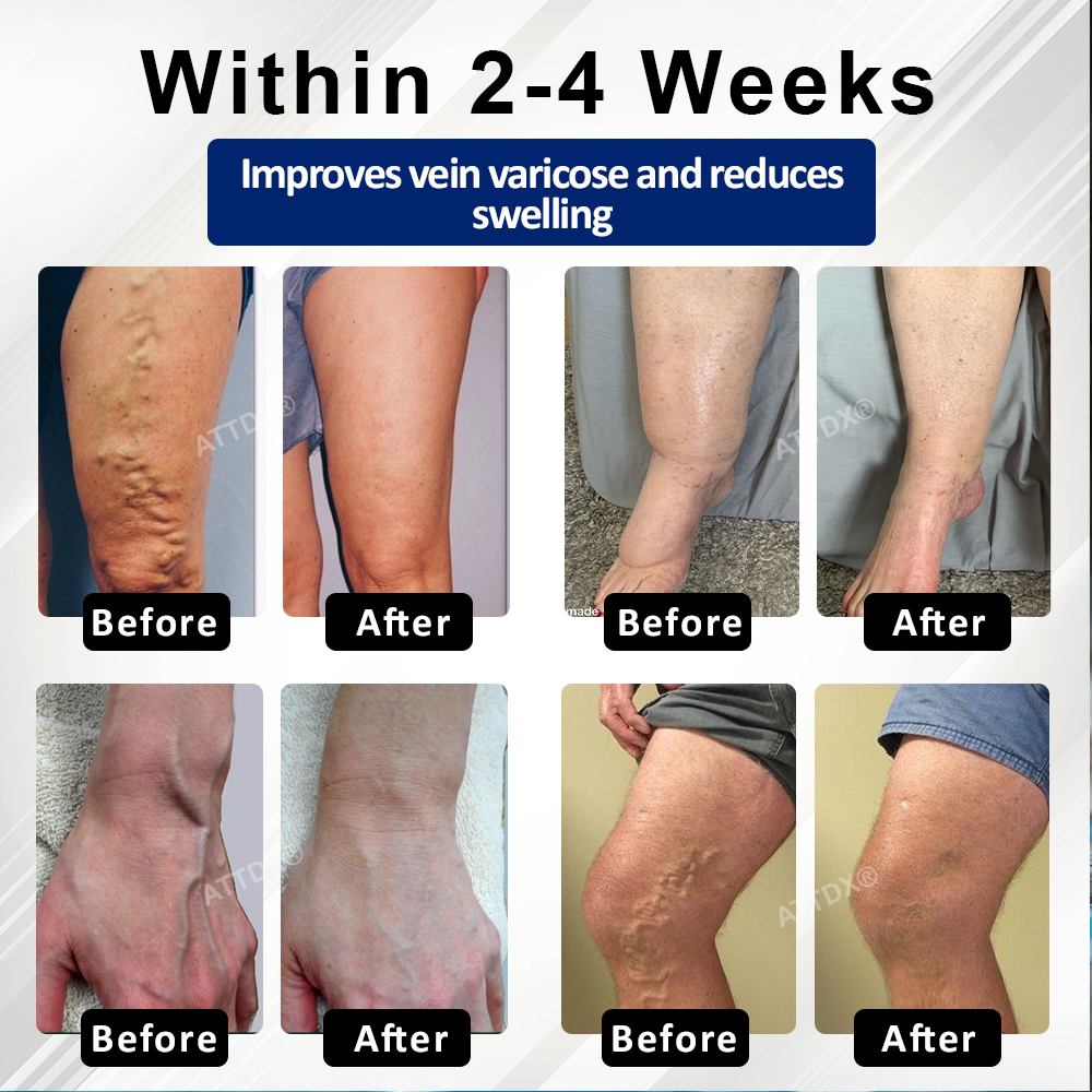 Cvreoz® VeinFocus Microneedle Leg Patch