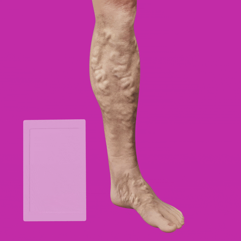 🩷 CVREOZ® VeinFlow Advanced Varicose Vein Patch 🦵🏻UP TO 60% OFF 🔥