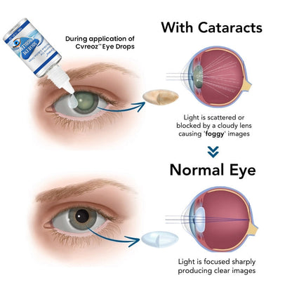 Cvreoz™ Myopia Reversal Eye Drops