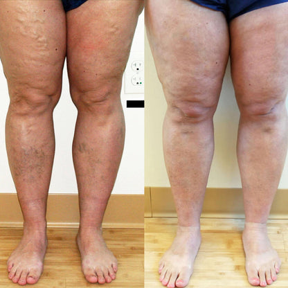 🔥 Last Day Promotion: 60% OFF 🔥 Cvreoz® Varicose Veins Healing Cream