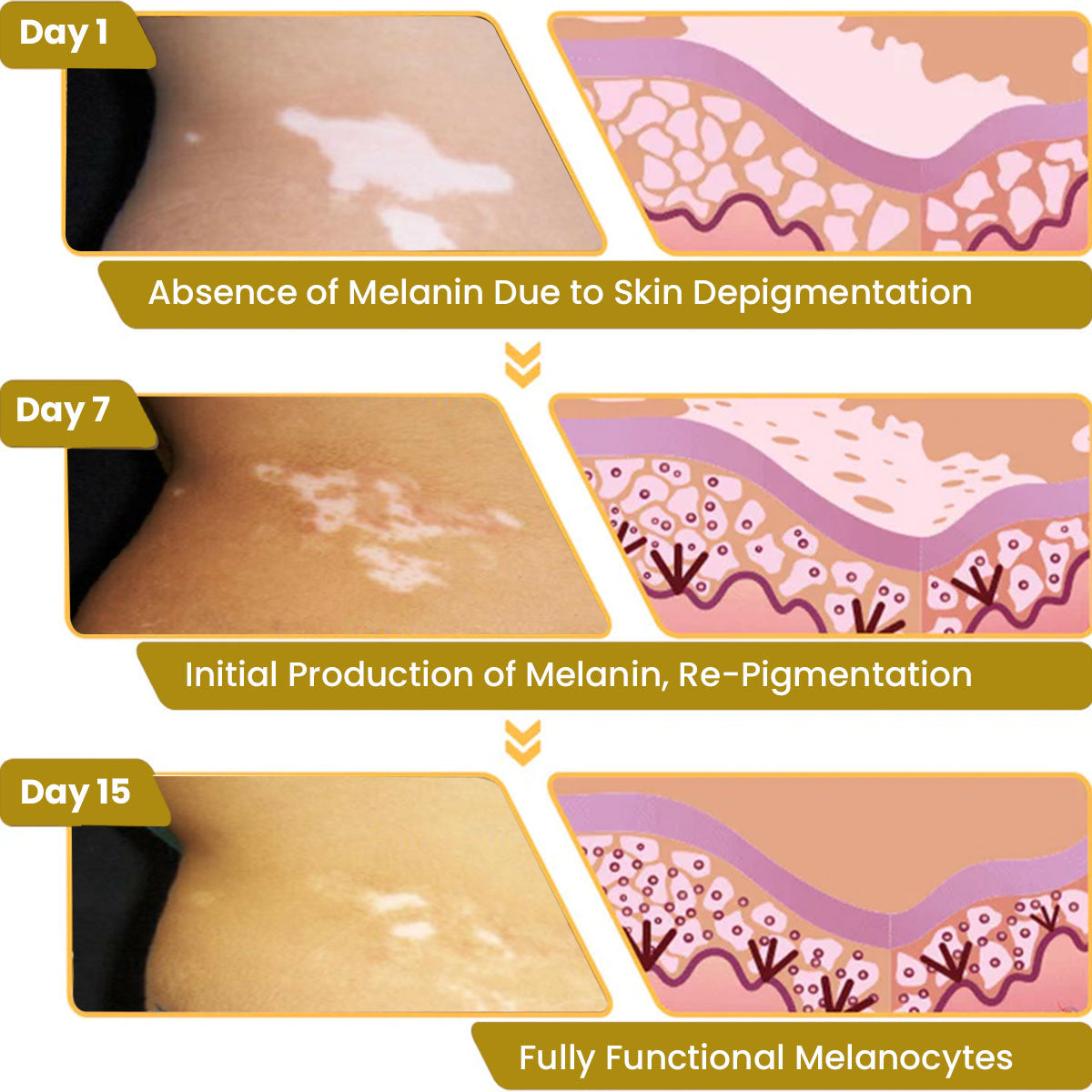 Cvreoz BeeVenom Vitiligo Remove Cream ⏰ Don't Wait - Last Day Sale Off 70% 💥