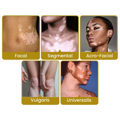 Cvreoz BeeVenom Vitiligo Remove Cream ⏰ Don't Wait - Last Day Sale Off 70% 💥