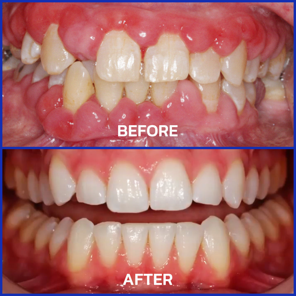 CVREOZ® Gum Therapy Focussmile Bee Venom Powder 🔬 Clinically Trusted by Dentists 🦷