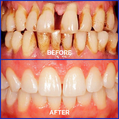 CVREOZ® Gum Therapy Focussmile Bee Venom Powder 🔬 Clinically Trusted by Dentists 🦷