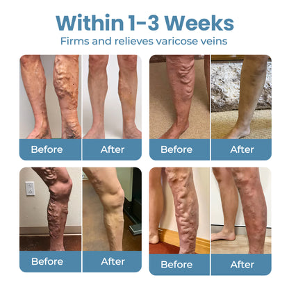 🔥Last Deal: 60% Off🔥 CVREOZ® Herbal Relief Varicose Vein Spray