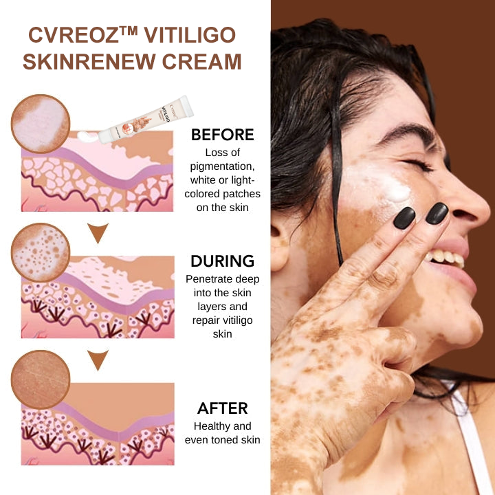 Cvreoz™ Vitiligo SkinRenew Cream 🔥 Save Big! 60% Off for a Limited Time! 🔥