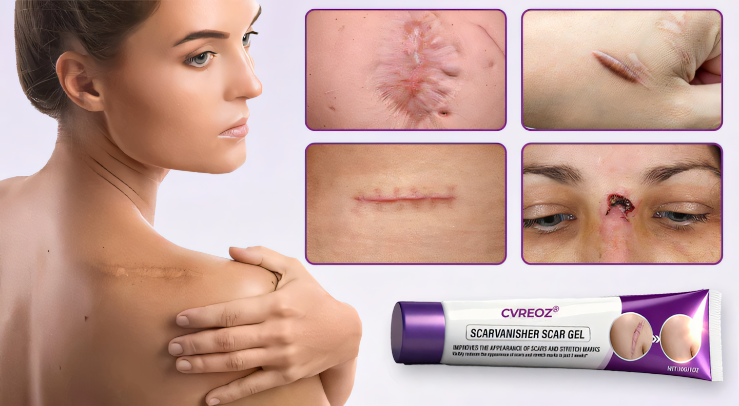 Cvreoz® ScarVanisher Scar Gel