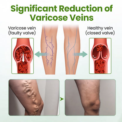 🔥 Last Day Promotion: 60% OFF 🔥 Cvreoz® Varicose Veins Healing Cream
