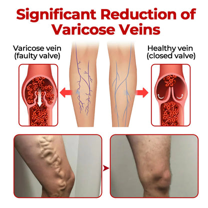CVREOZ® Varicose Veins Patch Ultra