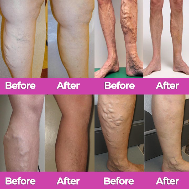 🩷 CVREOZ® VeinFlow Advanced Varicose Vein Patch 🦵🏻UP TO 60% OFF 🔥